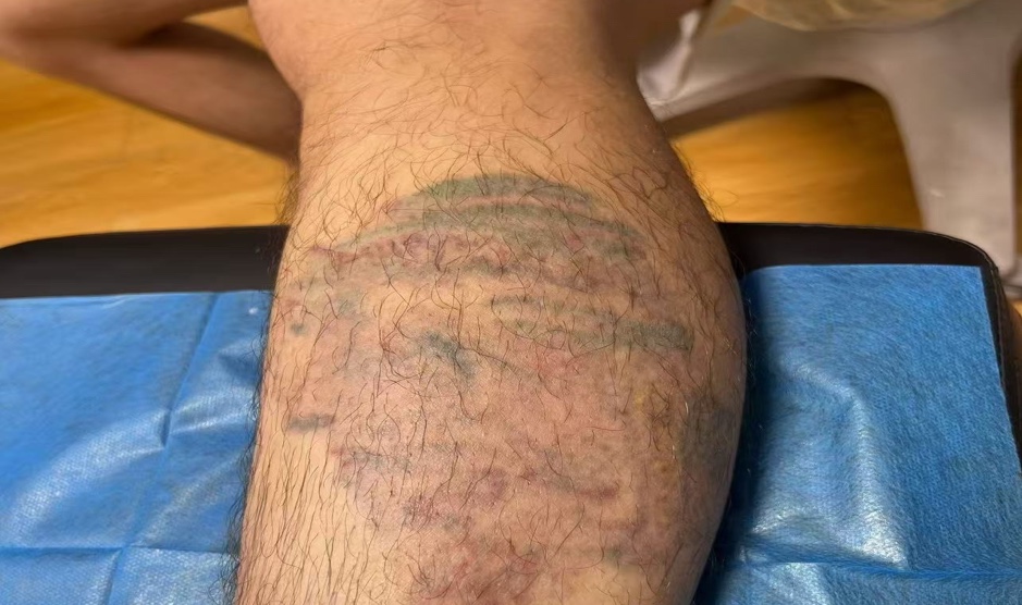 小腿彩色纹身治疗后淡化效果
